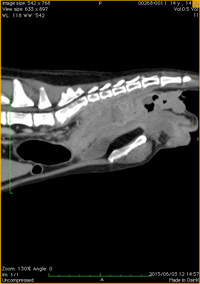 直腸腺癌と骨盤転移